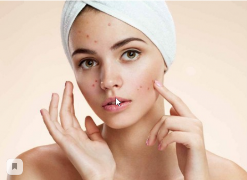 [Первая Школа Биохакинга] Акне (Ирина Баранова)